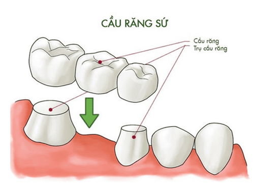 Làm cầu răng sứ có tốt không?