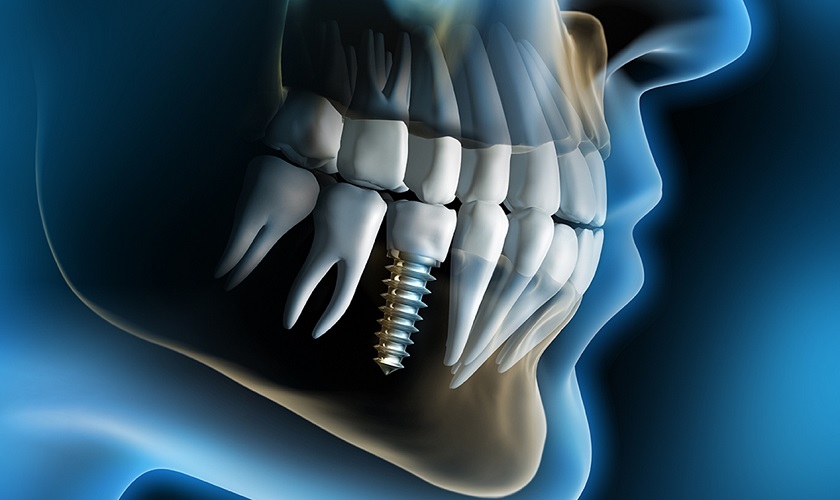 Tại sao nên cấy ghép Implant càng sớm càng tốt?