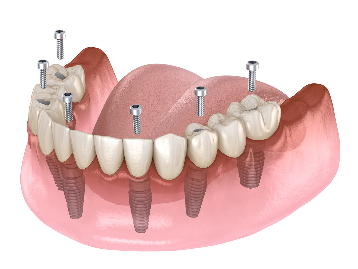 Cấy ghép Implant All on 4 – All on 6